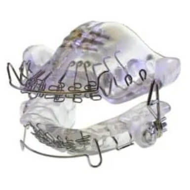 Custom vivos D N A appliance for sleep apnea treatment