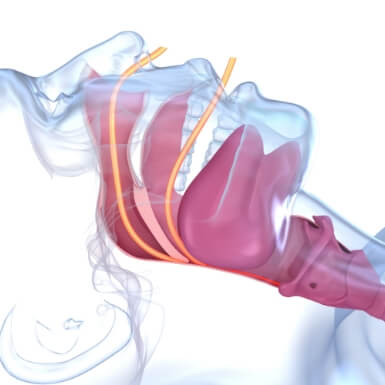 Animated airway obstructed due to sleep apnea